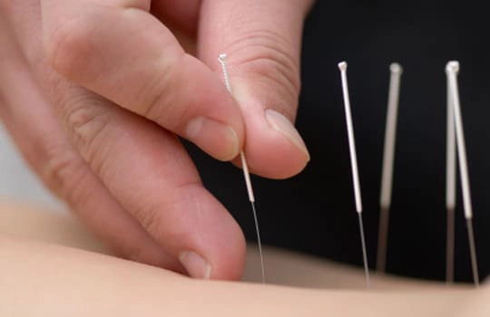 Traditional Chinese acupuncture practitioner at Health & Healing Wellness Centre clinic where expert acupuncturists provide a holistic treatment of the root cause of your problems