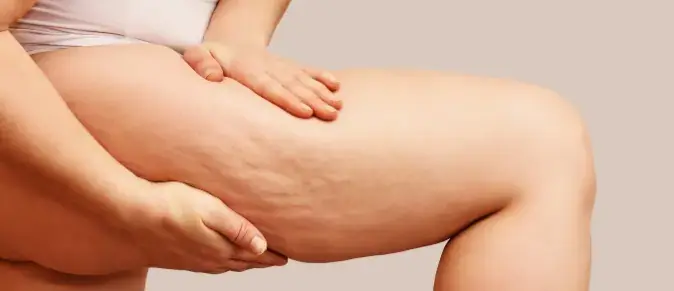 Women holding leg with cellulite present on her thigh