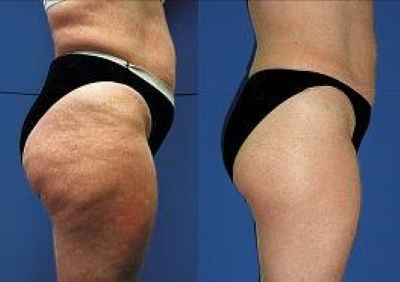 Cellulite reduction from Endermologie treatment