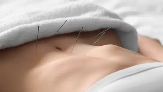 Fertility Acupuncture needles applied onto a woman's stomach 
