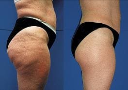 Endermologie Cellulite Reduction