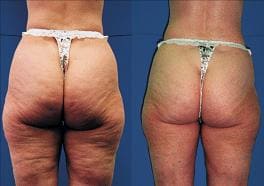 Cellulite Treatment Brisbane