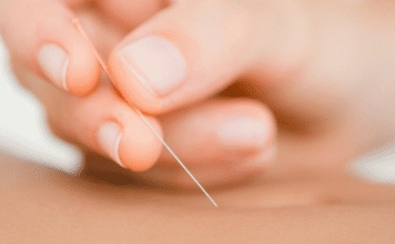 acupuncture Information