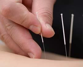 images/therapies-acupuncture