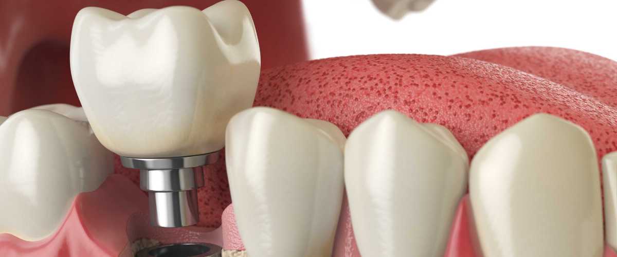 healthy teeth tooth dental implant