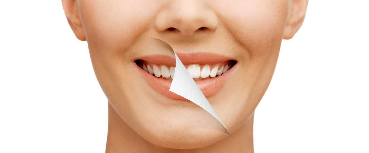 what-type-of-stains-can-teeth-whitening-fix