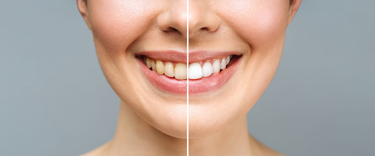 Teeth Whitening | At Home (DIY) vs Professional Treatment