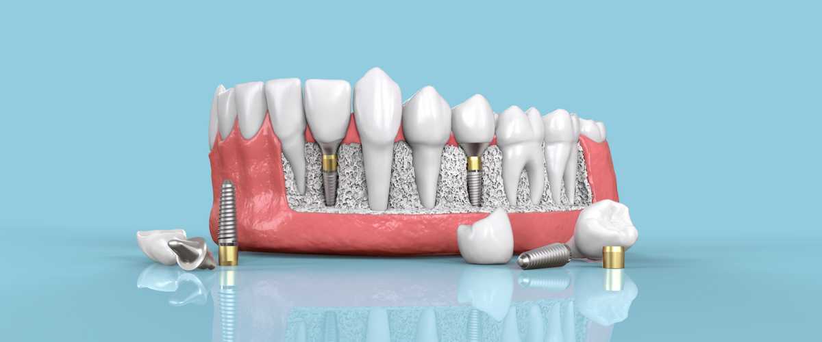 are-dental-implants-worth-it