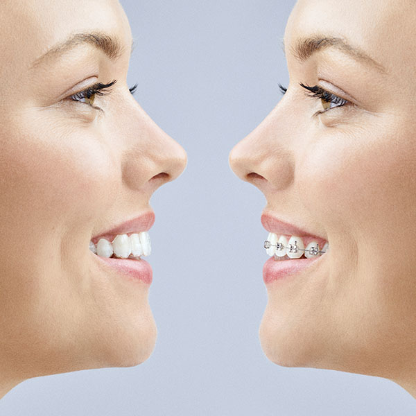 Invisalign vs Braces: Which is better?