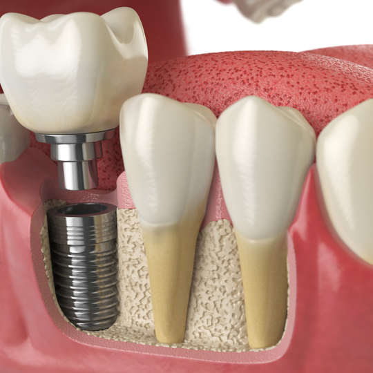 healthy teeth tooth dental implant