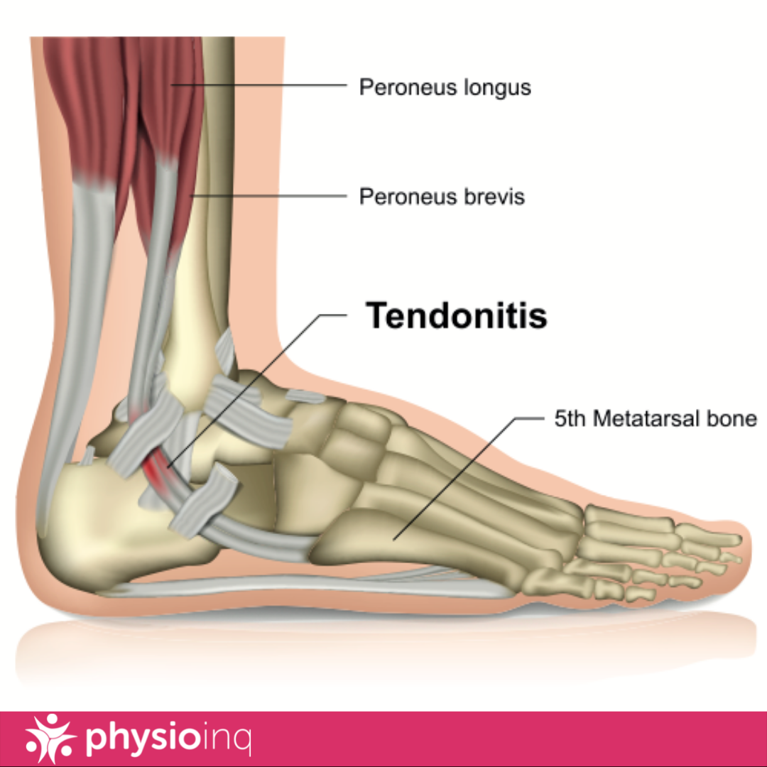 How does manual therapy help tendonitis?
