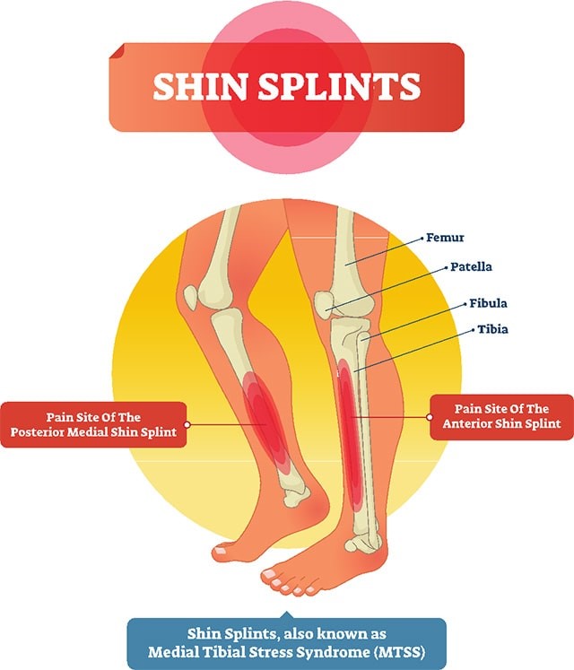 The 6 Most Common Netball Injuries and How to Prevent Them