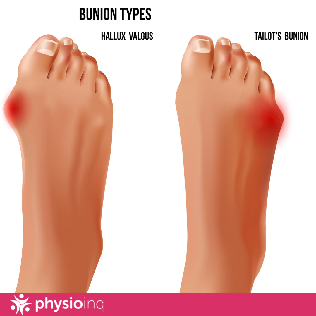 Blisters on Feet: Causes and Treatments