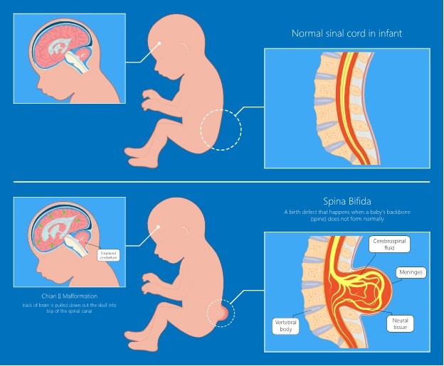 Spina Bifida Physiotherapy Management What You Need To Know 8116