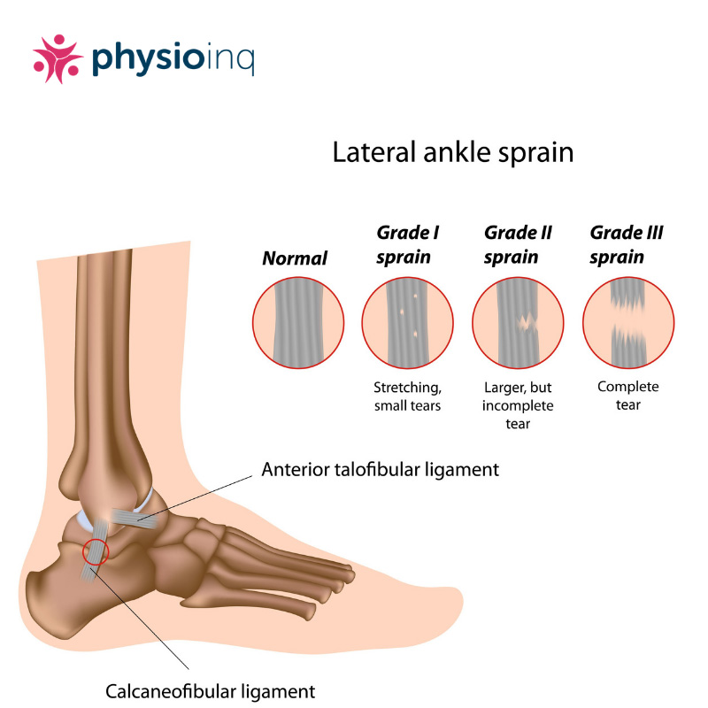 Ankle Sprains | Why Do They Happen Again & Again?