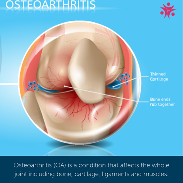 How Can Physiotherapy Help Osteoarthritis? What You Need to Know