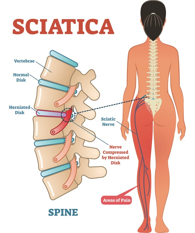 Sitting position for sciatica pain sale