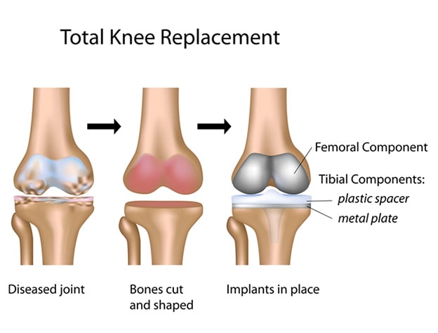 What to Expect After Knee Replacement Surgery? All Questions Answered