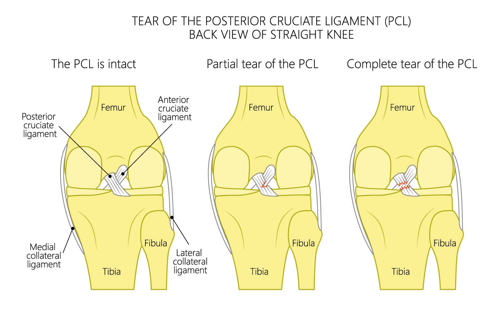 Can You Play Football With Torn Acl