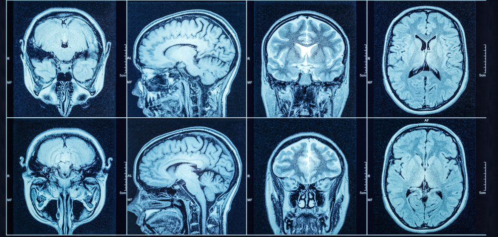 Improving Outcomes for Traumatic Brain Injury Patients: How Collaborative Therapy Enhances Recovery 