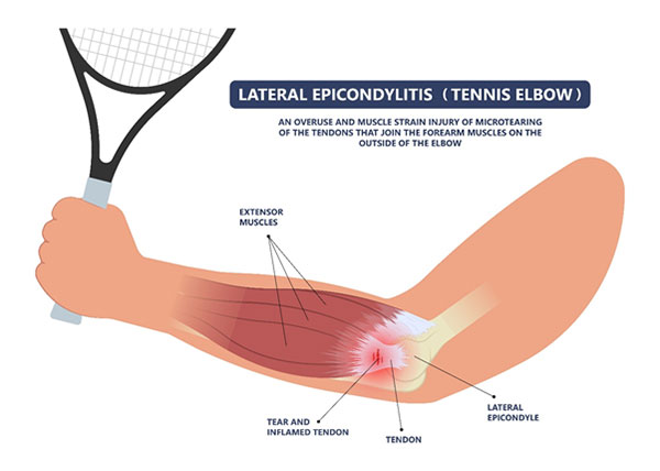 Tennis Elbow | Chronic Tennis Elbow Treatment
