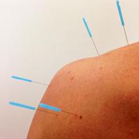 The Ins and Outs of Dry Needling