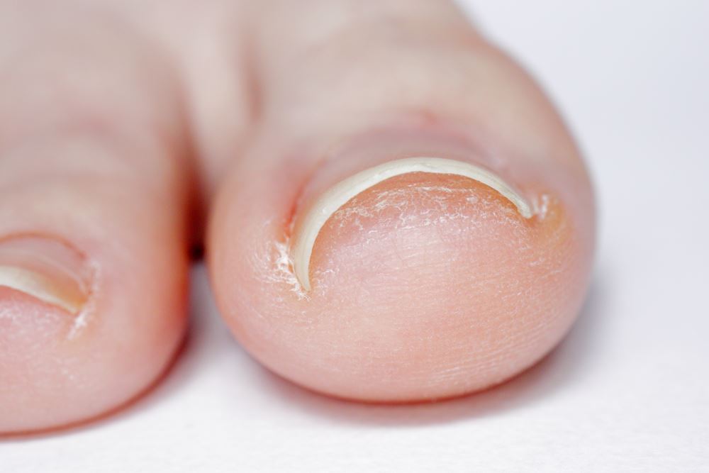In-grown Toe Nails