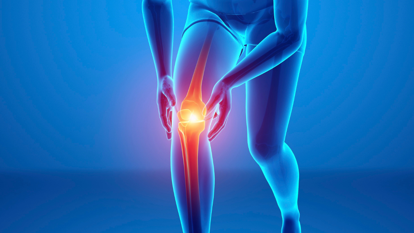 Knee: Rheumatoid Arthritis of the Knee