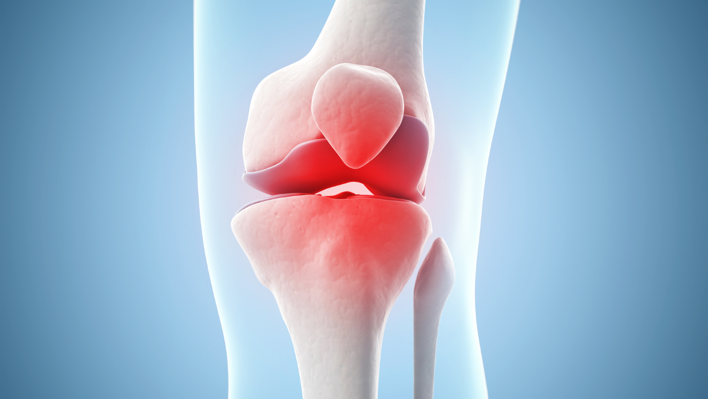 Knee: Meniscus Tears
