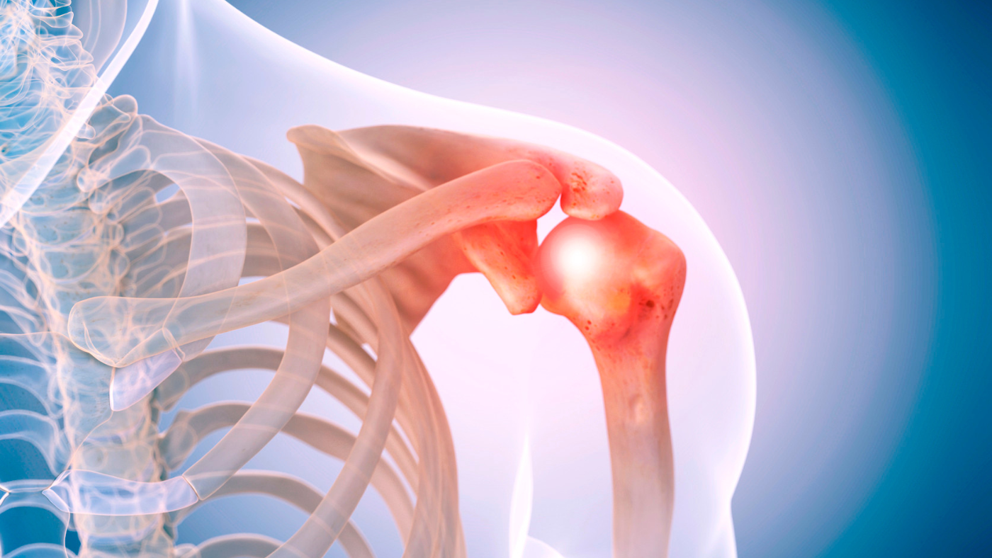 Shoulder: AC Joint Arthritis