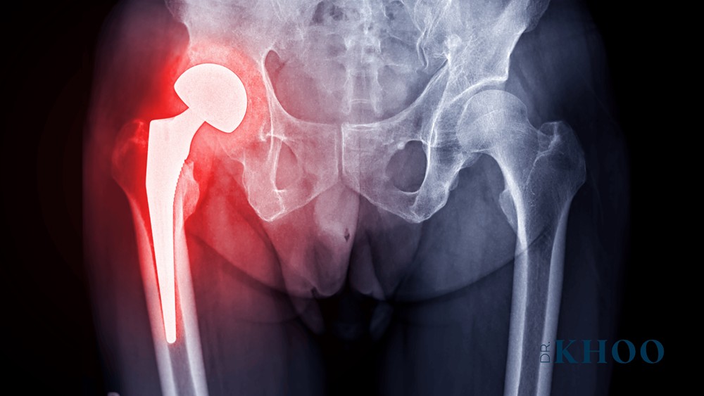 Do I Really Need a Hip Replacement? Should I Get a Second Opinion?