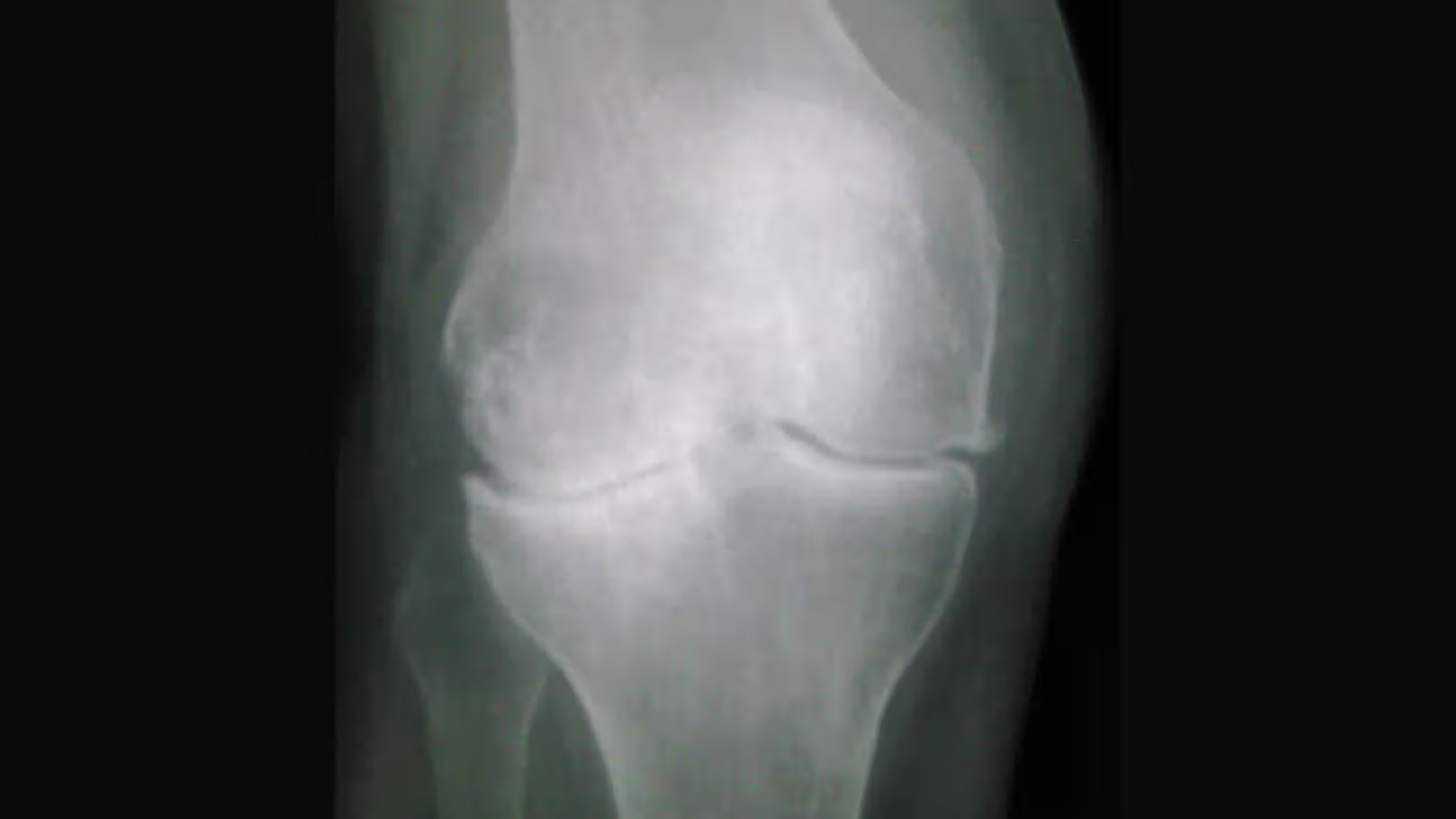 Knee Osteoarthritis Management for GPs 2025 - updated