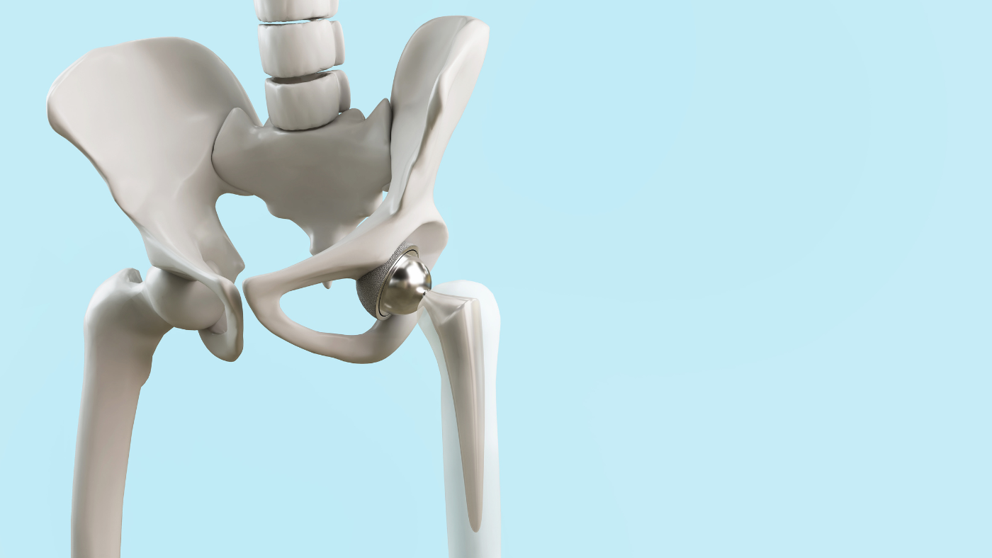 Partial Hip Replacement Surgery in Griffith - Orthopaedic Surgeon - Dr. Oliver Khoo