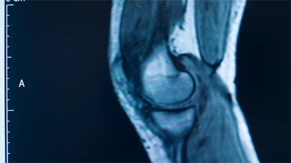 Knee: ACL Reconstruction Surgery