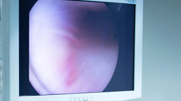 Shoulder: Arthroscopic Capsular Release for Frozen Shoulder