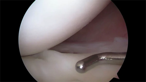 Shoulder: Arthroscopic Labral Repair