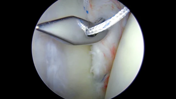 Shoulder: Shoulder Stabilisation Surgery (Bankart Repair)