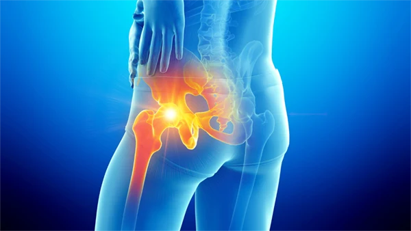 Hip: Corticosteroid Injections for Hip Pain