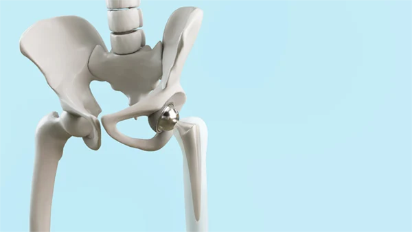 Hip: Total Hip Replacement