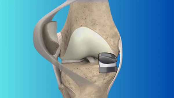 Knee: Partial Knee Replacement
