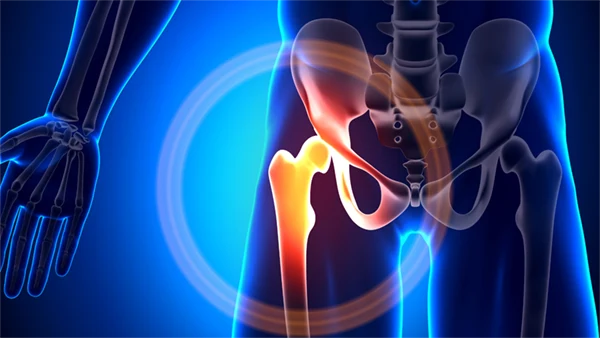 Hip: Periacetabular Osteotomy (PAO) Surgery