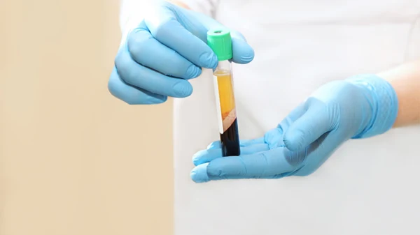 Knee: PRP Injections for Knee Pain