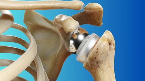 Shoulder: Reverse Shoulder Replacement