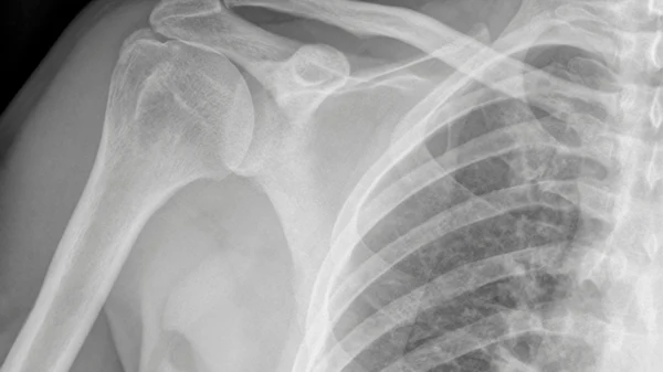 Shoulder: Rotator Cuff Repair Surgery