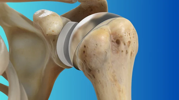 Shoulder: Total Shoulder Replacement